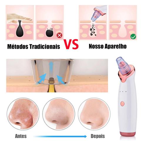 Limpador de cravos facial a vacuum